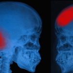 HeadInjury HeadInjury